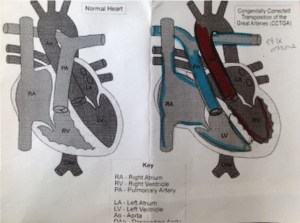 A normal heart on the left. Wes's heart (pre-surgery) on the right.